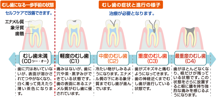 むし歯の進行