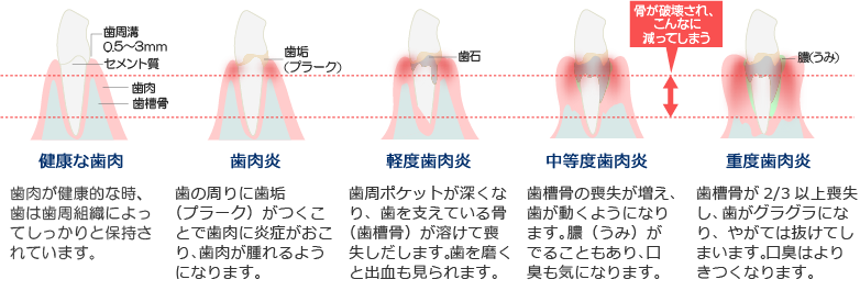 歯周病の症状と進行の様子