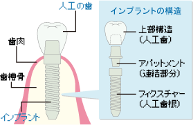 インプラントの構造